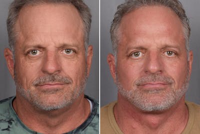 Facelift Before & After Gallery - Patient 337697 - Image 1
