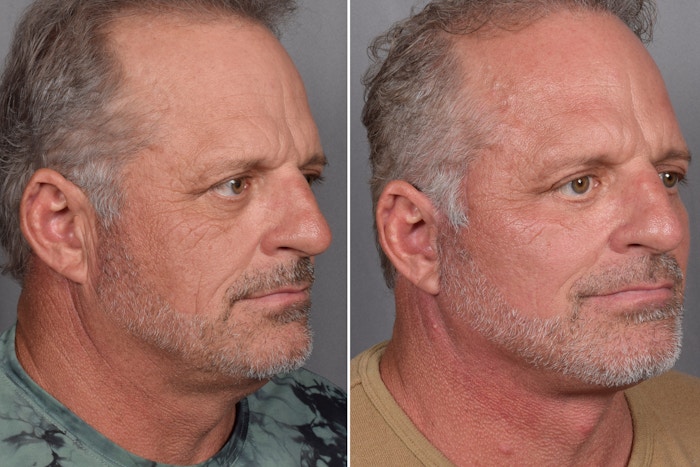 Facelift Before & After Gallery - Patient 337697 - Image 1