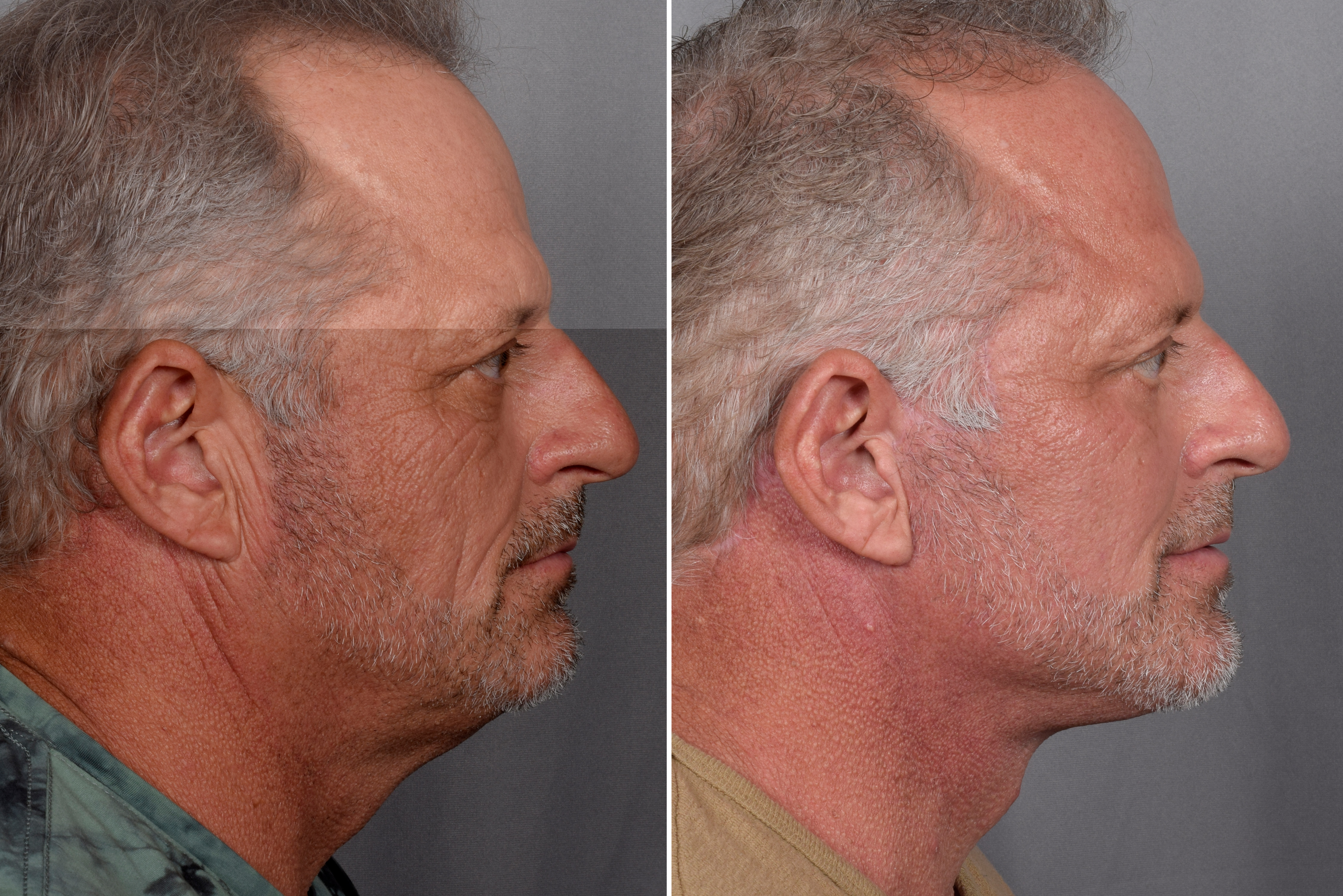 Facelift Before & After Gallery - Patient 337697 - Image 2