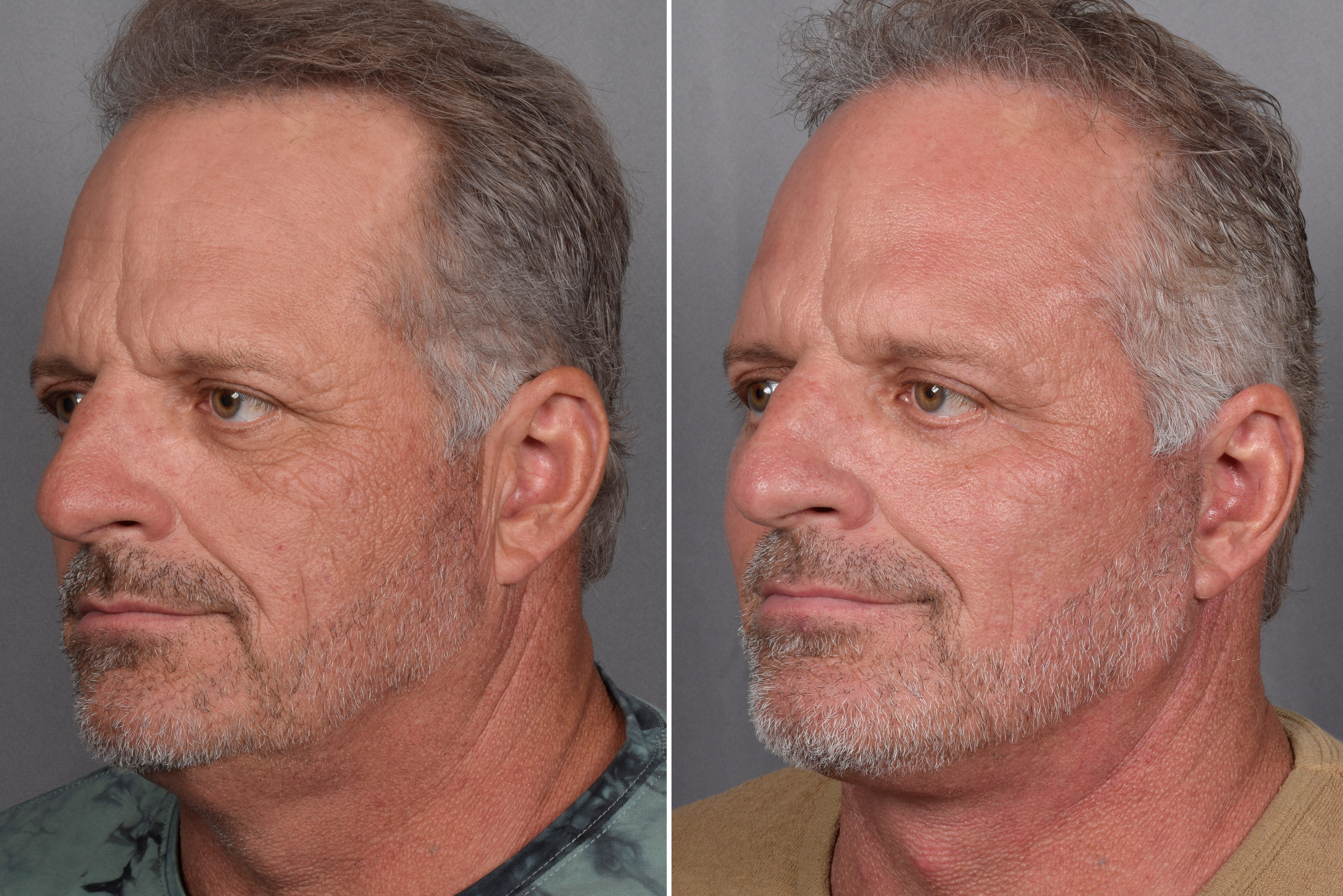 Facelift Before & After Gallery - Patient 337697 - Image 4