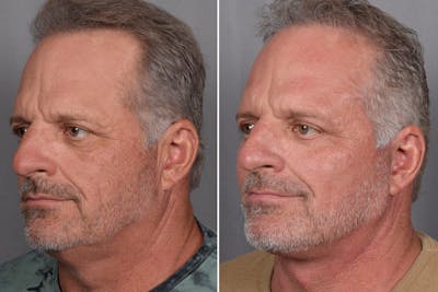 Facelift Before & After Gallery - Patient 337697 - Image 1