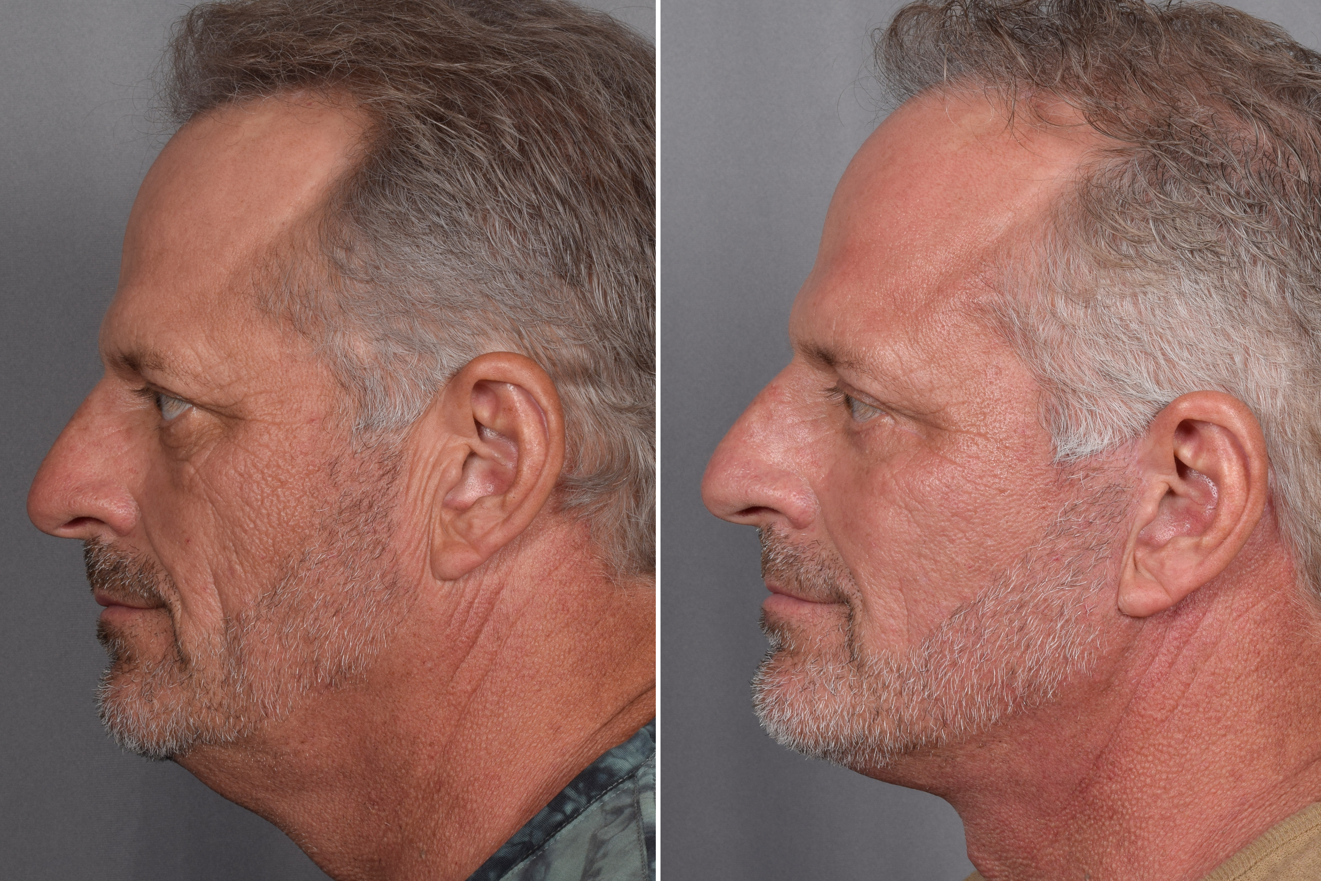 Facelift Before & After Gallery - Patient 337697 - Image 5