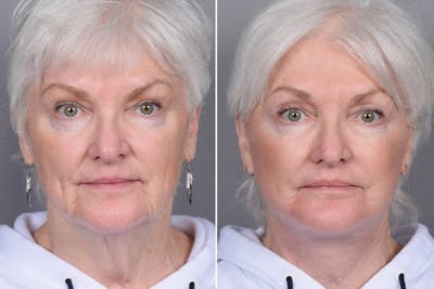 Facelift Before & After Gallery - Patient 370906 - Image 1