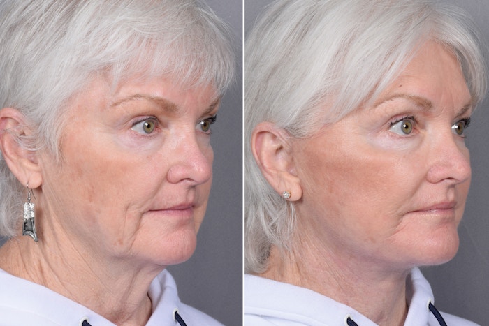 Facelift Before & After Gallery - Patient 370906 - Image 1