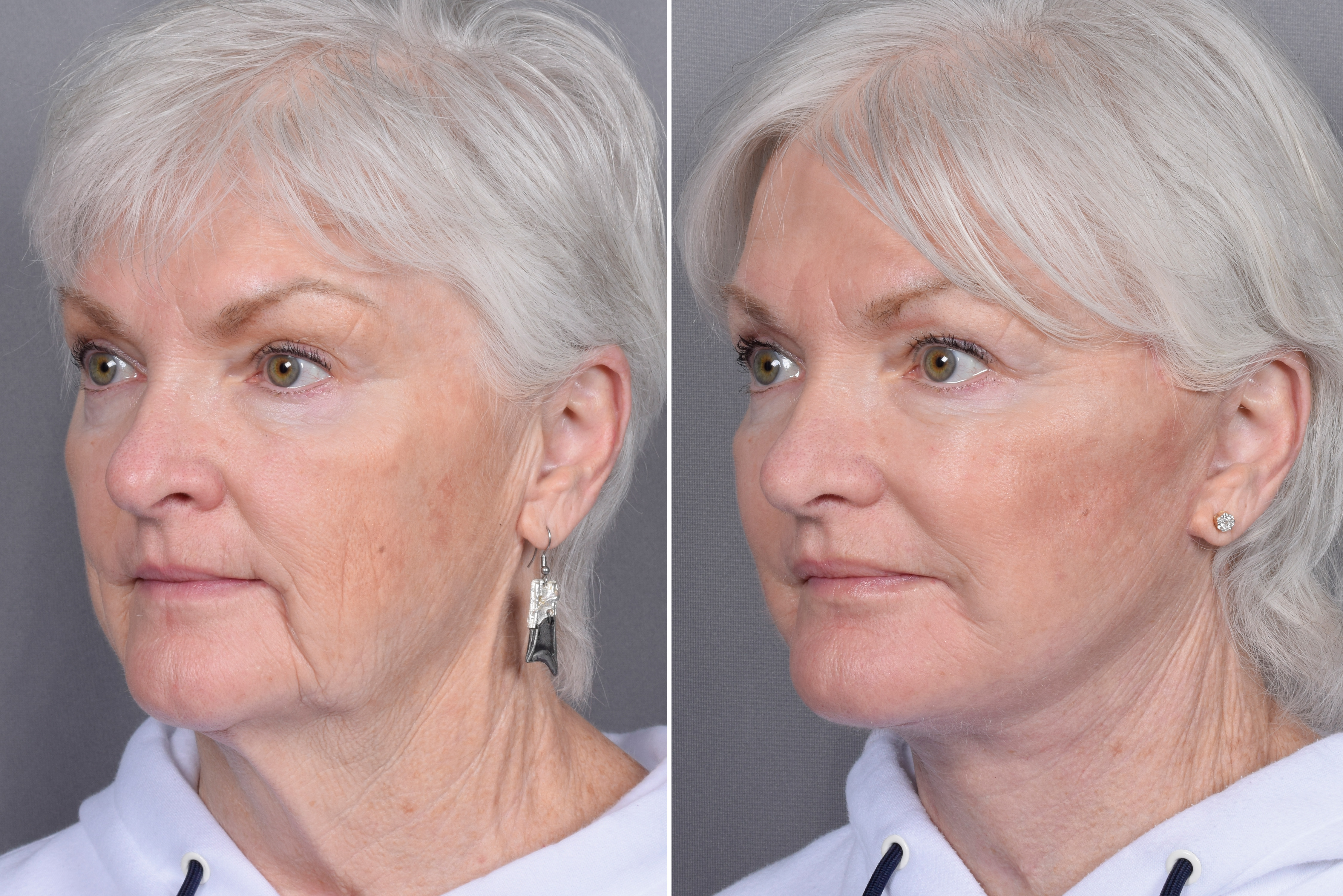 Facelift Before & After Gallery - Patient 370906 - Image 2