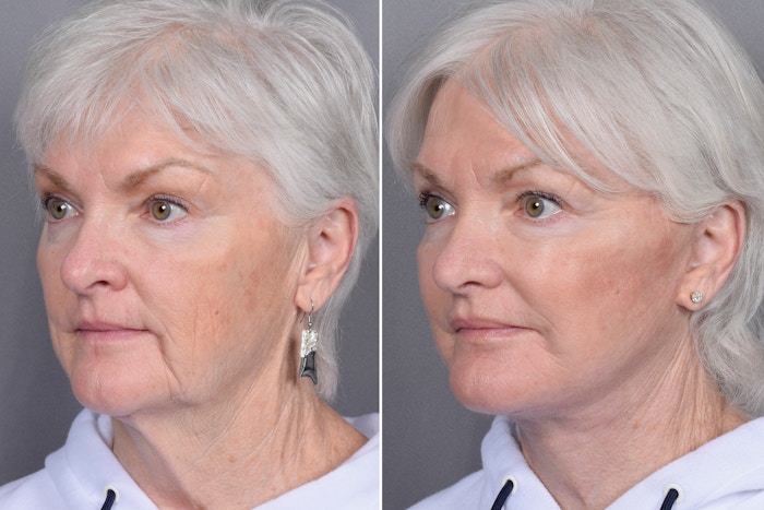 Facelift Before & After Gallery - Patient 370906 - Image 1