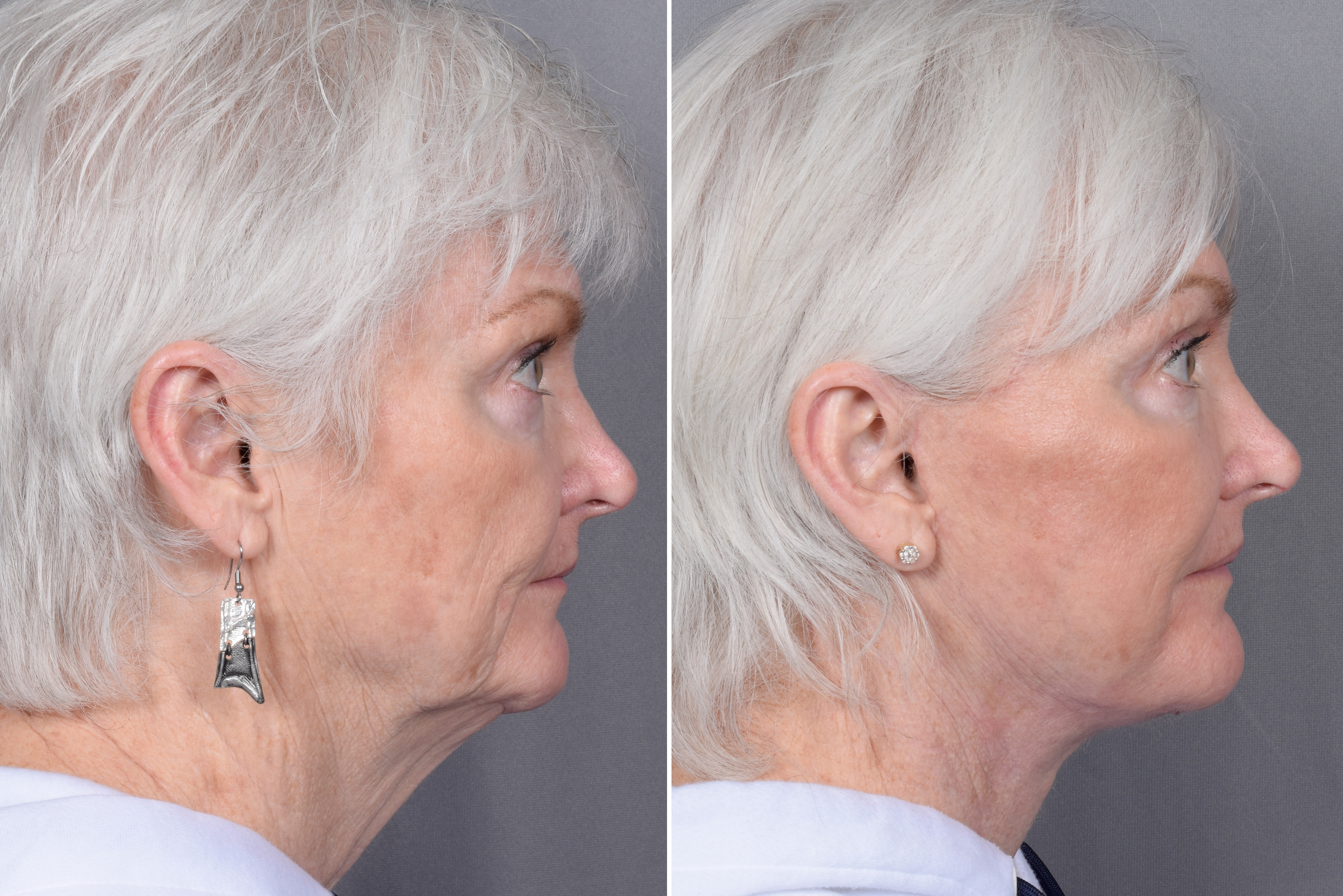 Facelift Before & After Gallery - Patient 370906 - Image 5