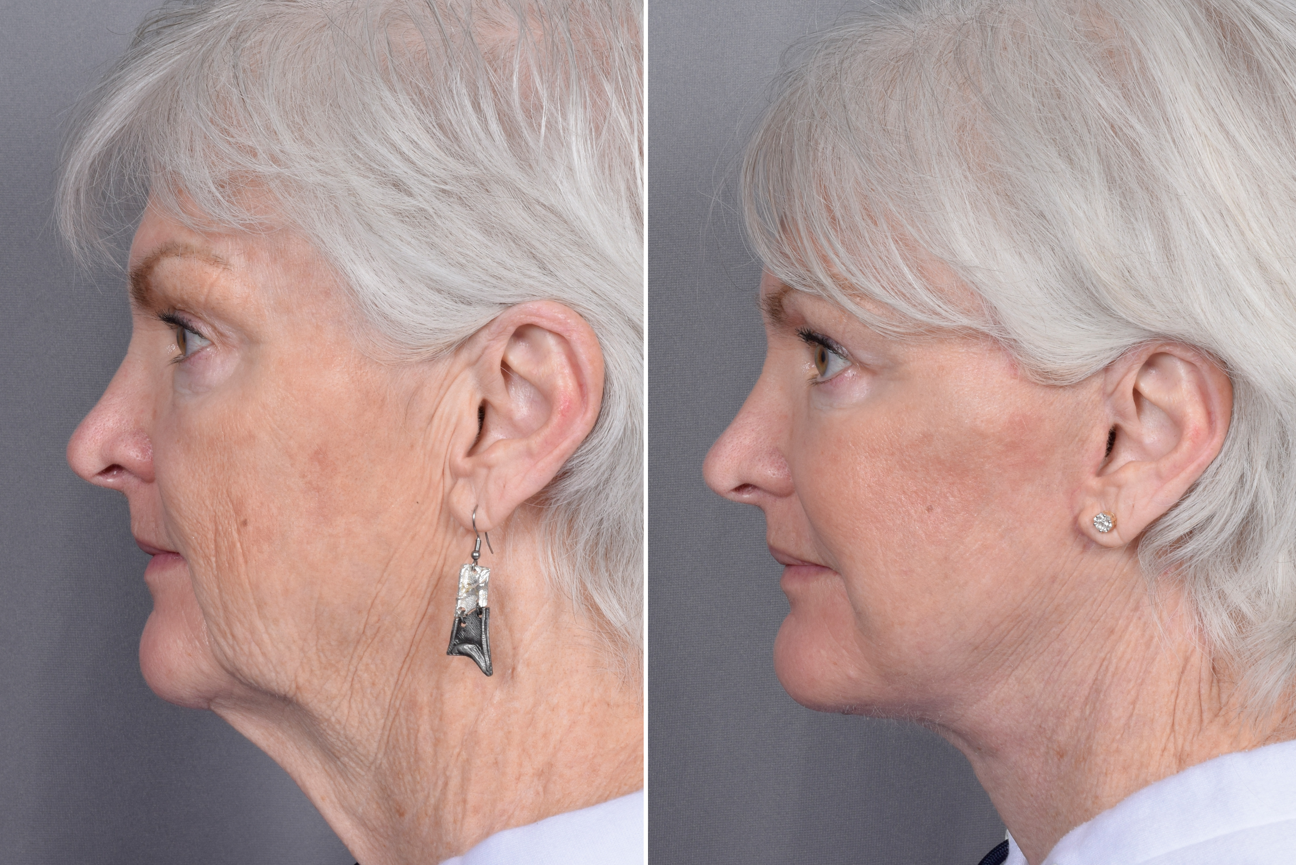 Facelift Before & After Gallery - Patient 370906 - Image 1