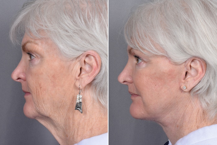 Facelift Before & After Gallery - Patient 370906 - Image 1