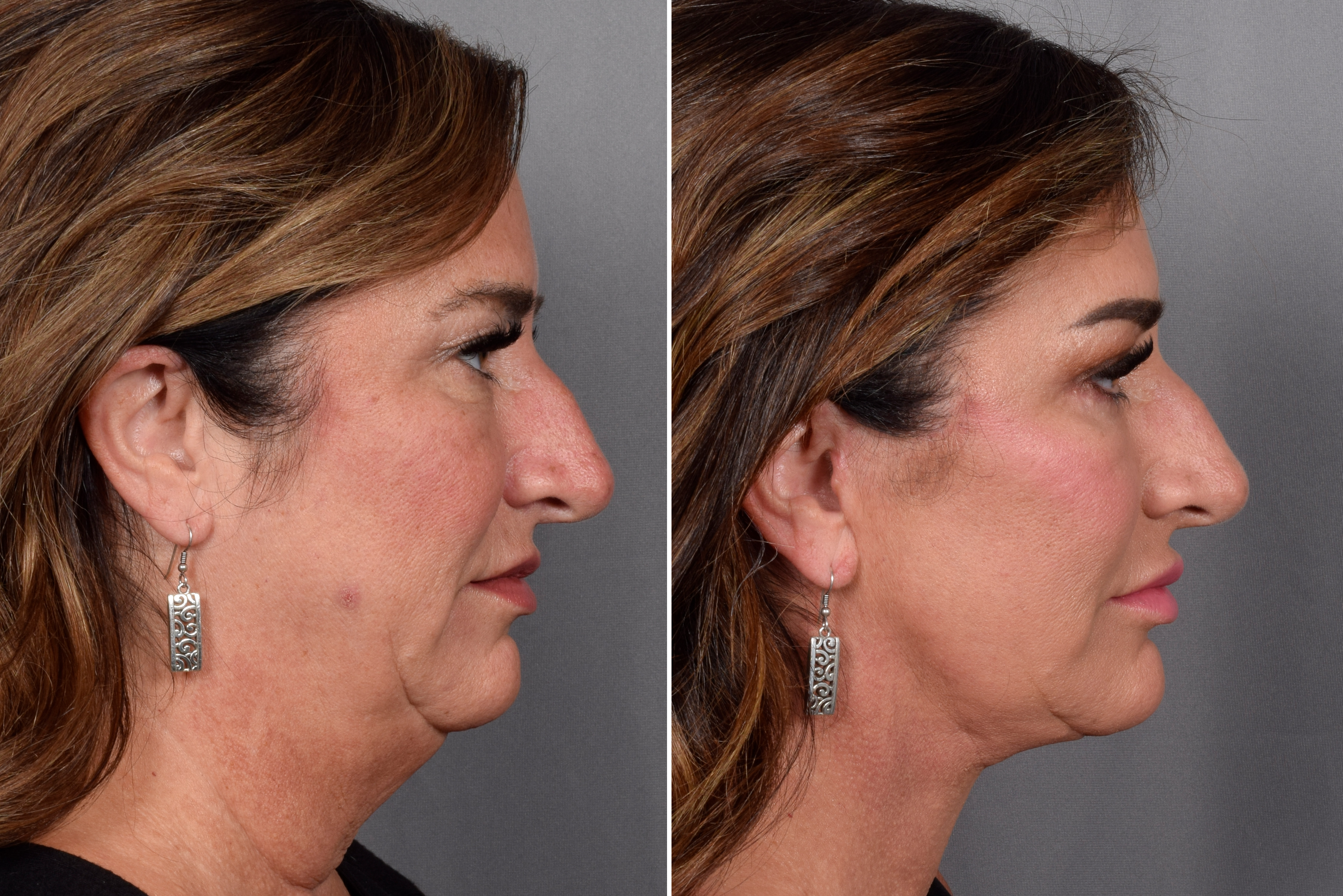 Neck Lift Before & After Gallery - Patient 837658 - Image 6