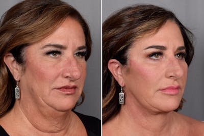 CO2 Laser Before & After Gallery - Patient 314223 - Image 1