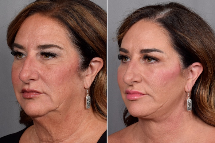 Facelift Before & After Gallery - Patient 265637 - Image 1