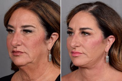 Facelift Before & After Gallery - Patient 265637 - Image 1