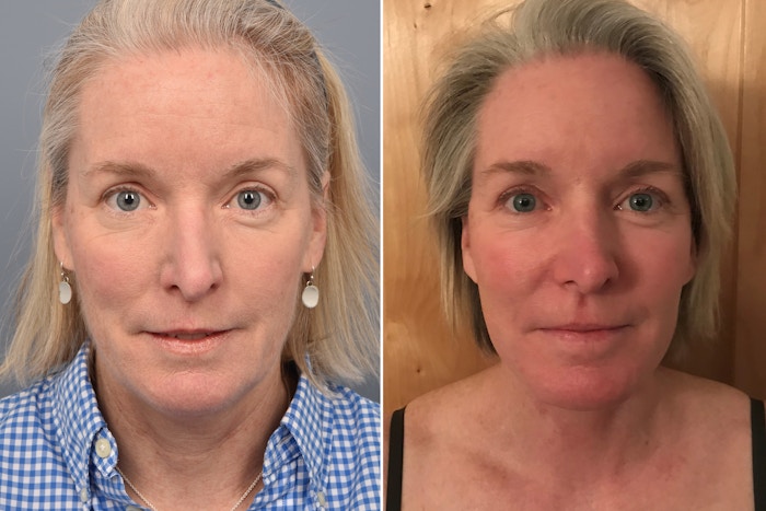 Facelift Before & After Gallery - Patient 102169 - Image 1