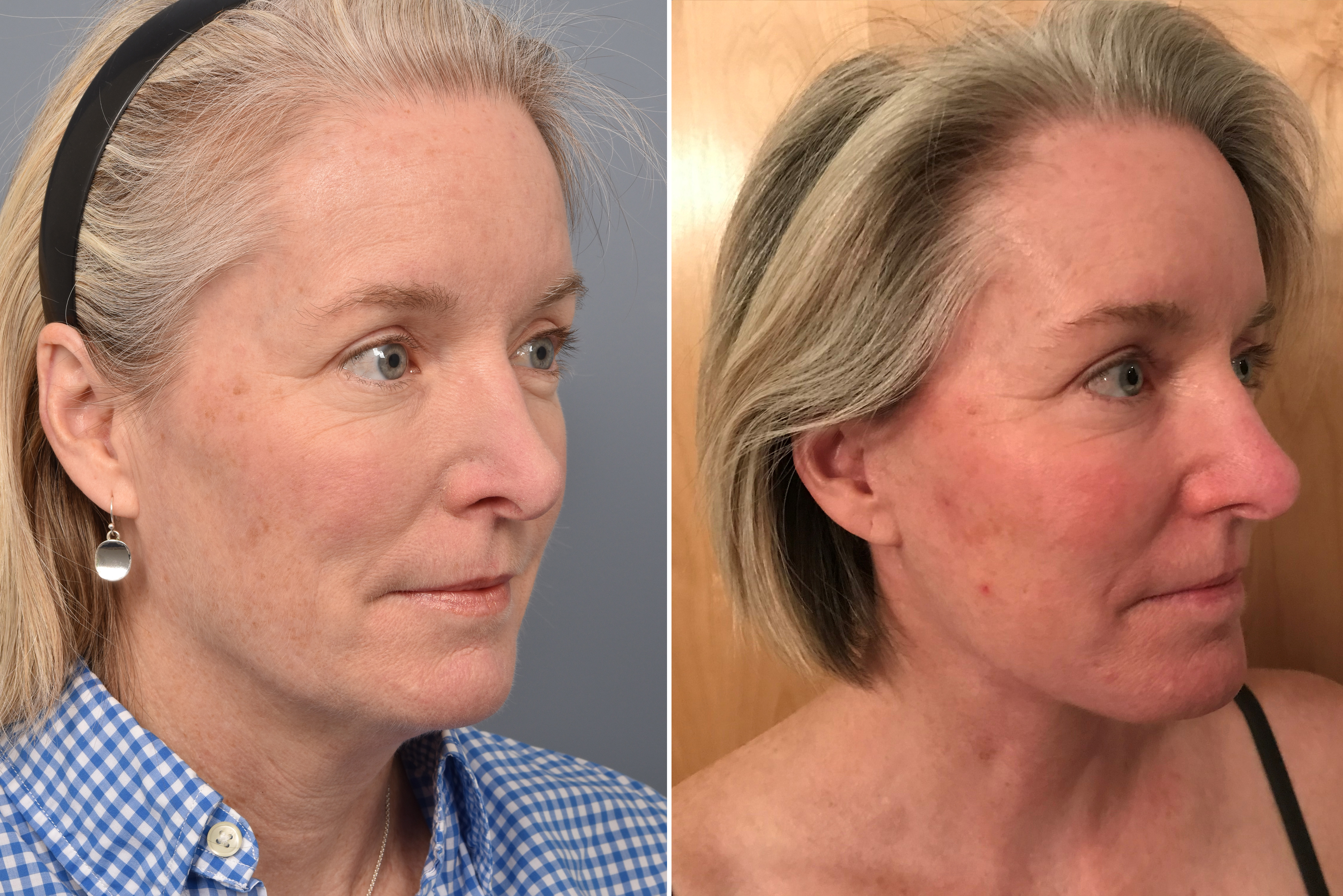 CO2 Laser Before & After Gallery - Patient 247083 - Image 1