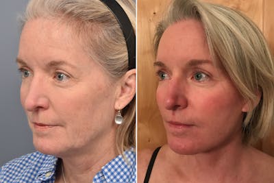 Facelift Before & After Gallery - Patient 102169 - Image 1