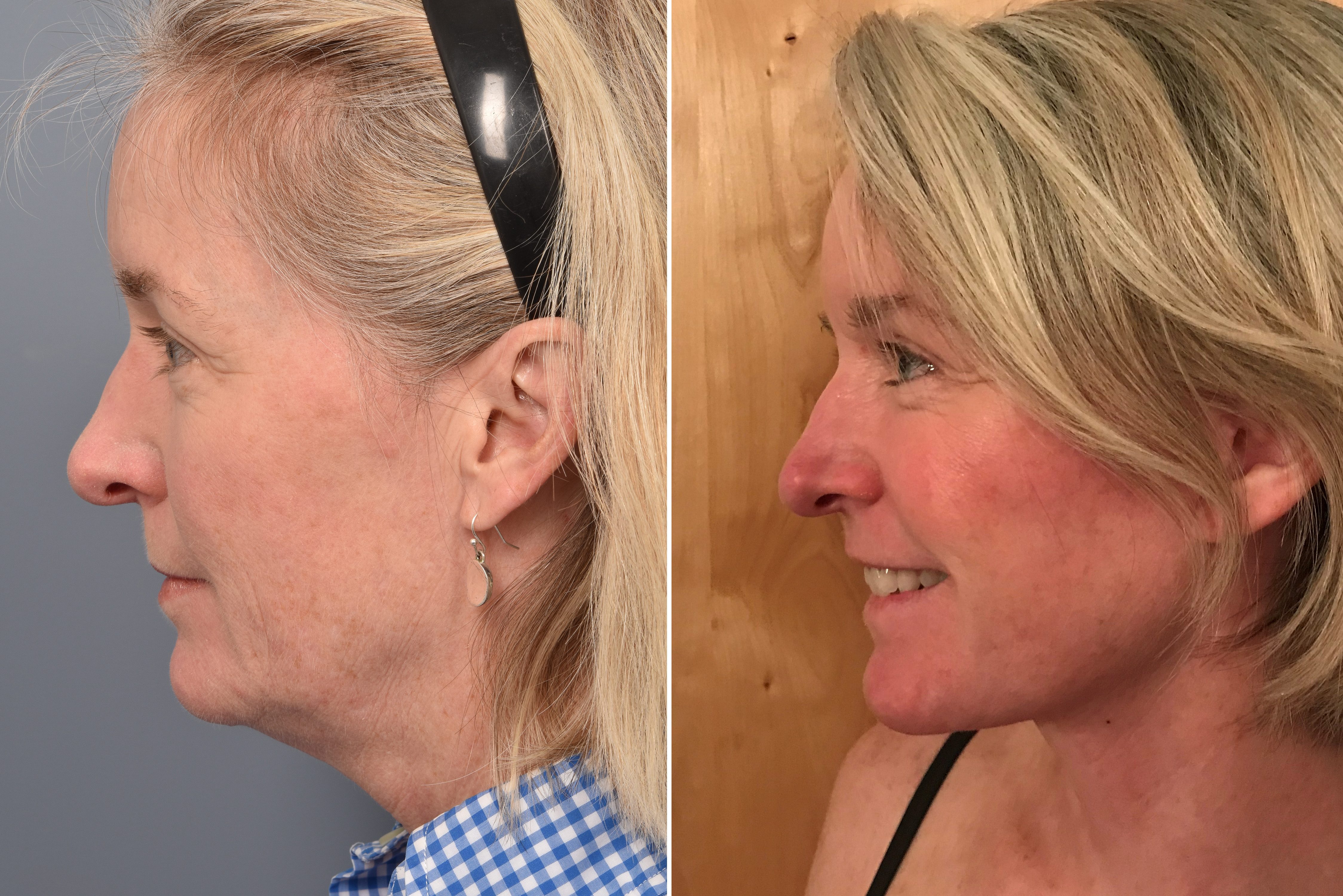 CO2 Laser Before & After Gallery - Patient 247083 - Image 5