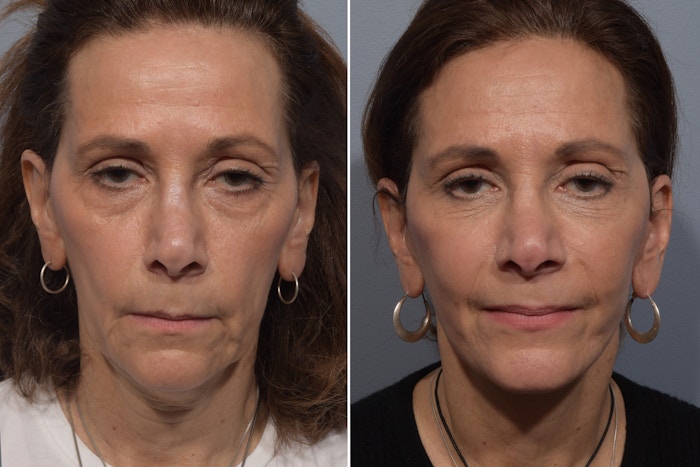 Facelift Before & After Gallery - Patient 168748 - Image 1
