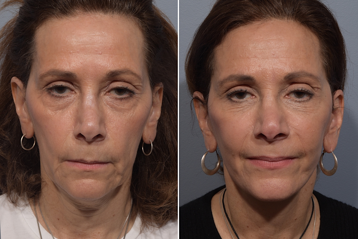 Neck Lift Before & After Gallery - Patient 150533 - Image 8