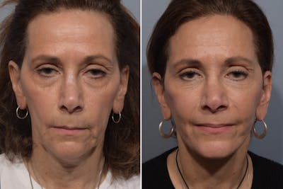 Facelift Before & After Gallery - Patient 168748 - Image 1