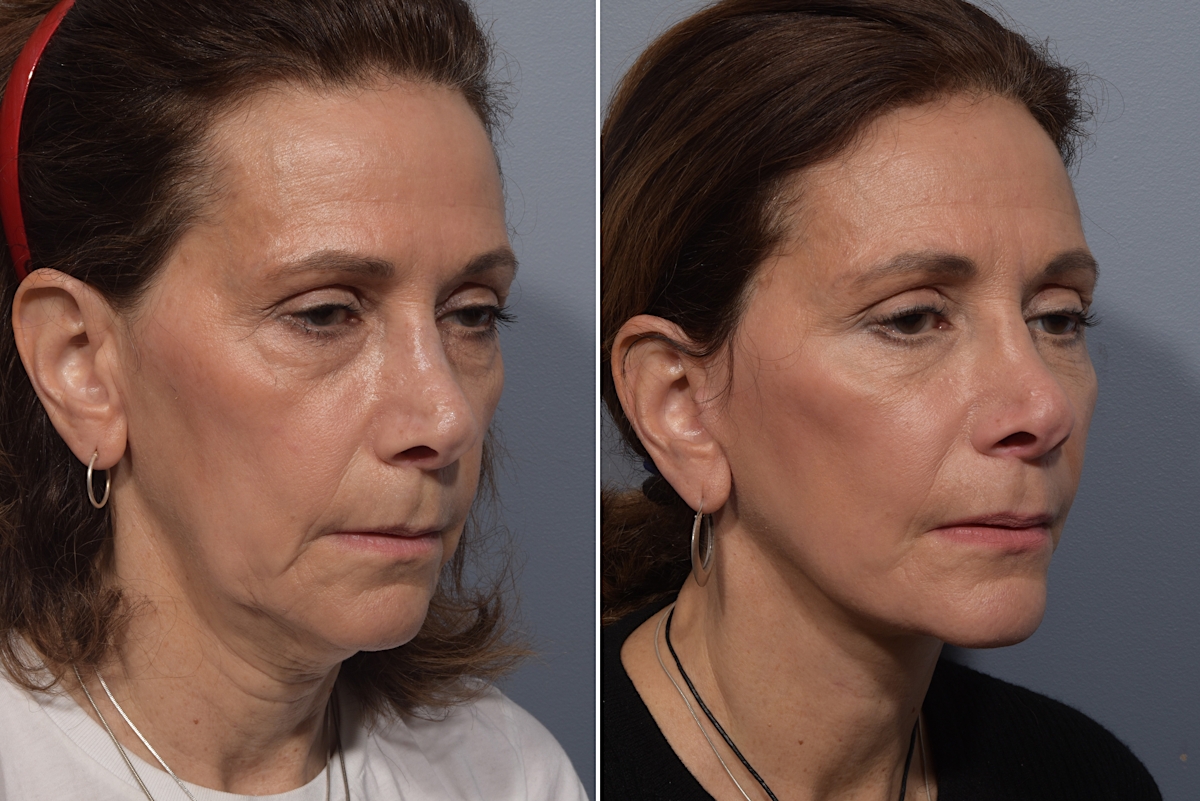 Neck Lift Before & After Gallery - Patient 150533 - Image 6