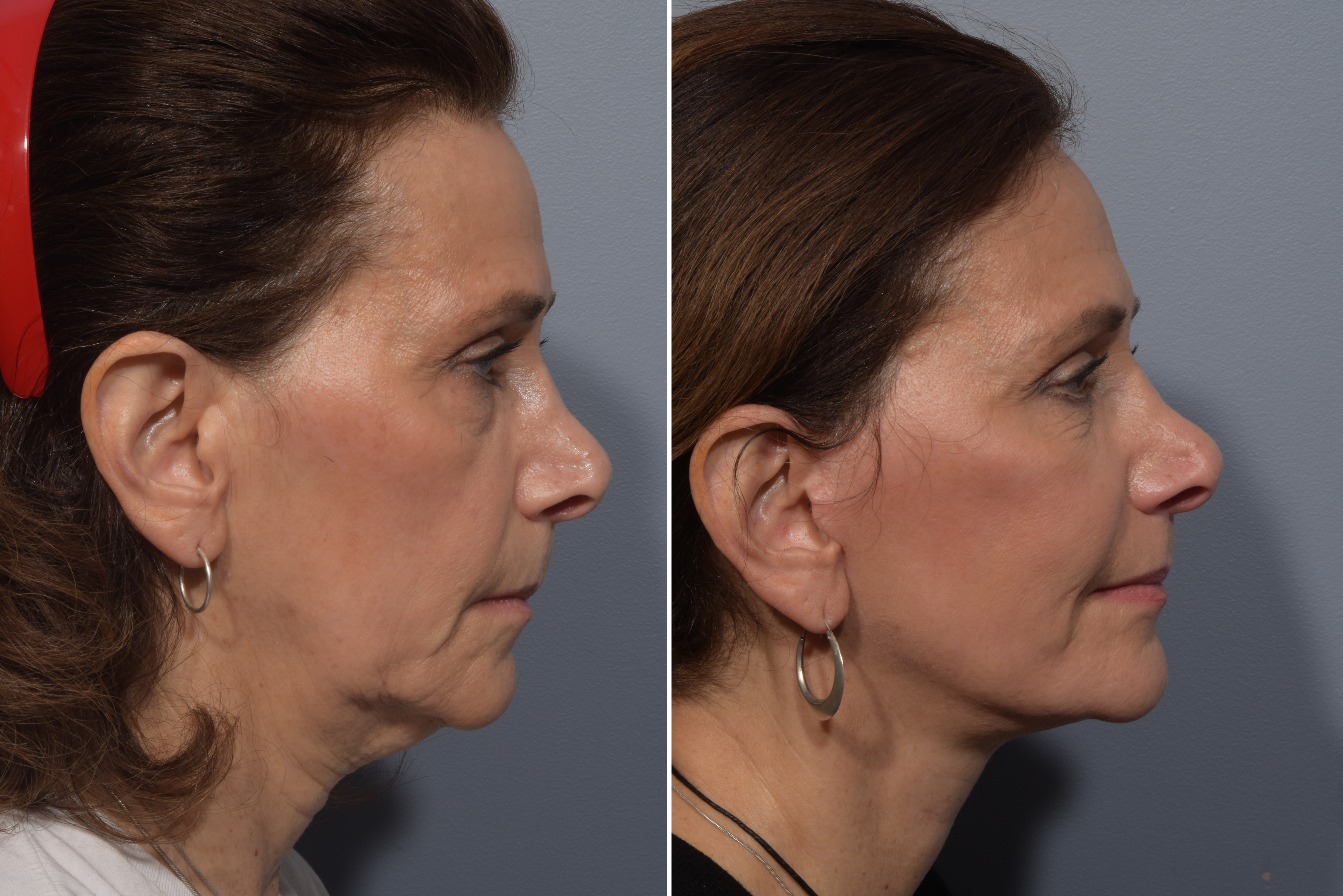 CO2 Laser Before & After Gallery - Patient 246063 - Image 2
