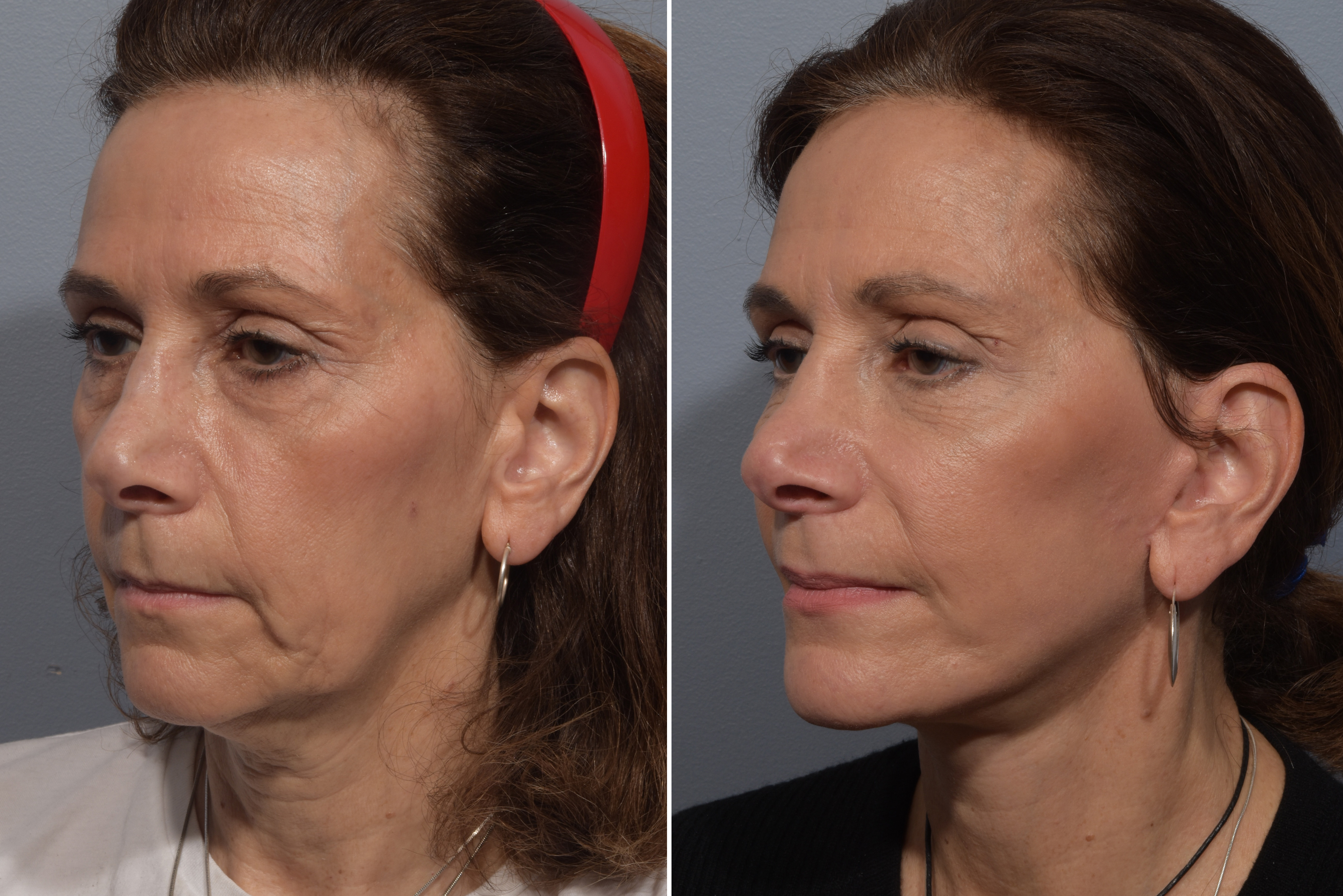 CO2 Laser Before & After Gallery - Patient 246063 - Image 4