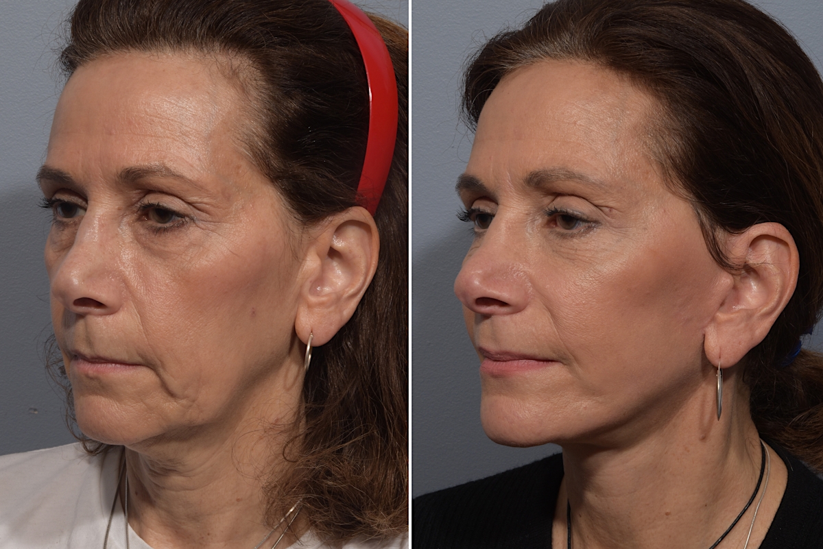 Neck Lift Before & After Gallery - Patient 150533 - Image 9