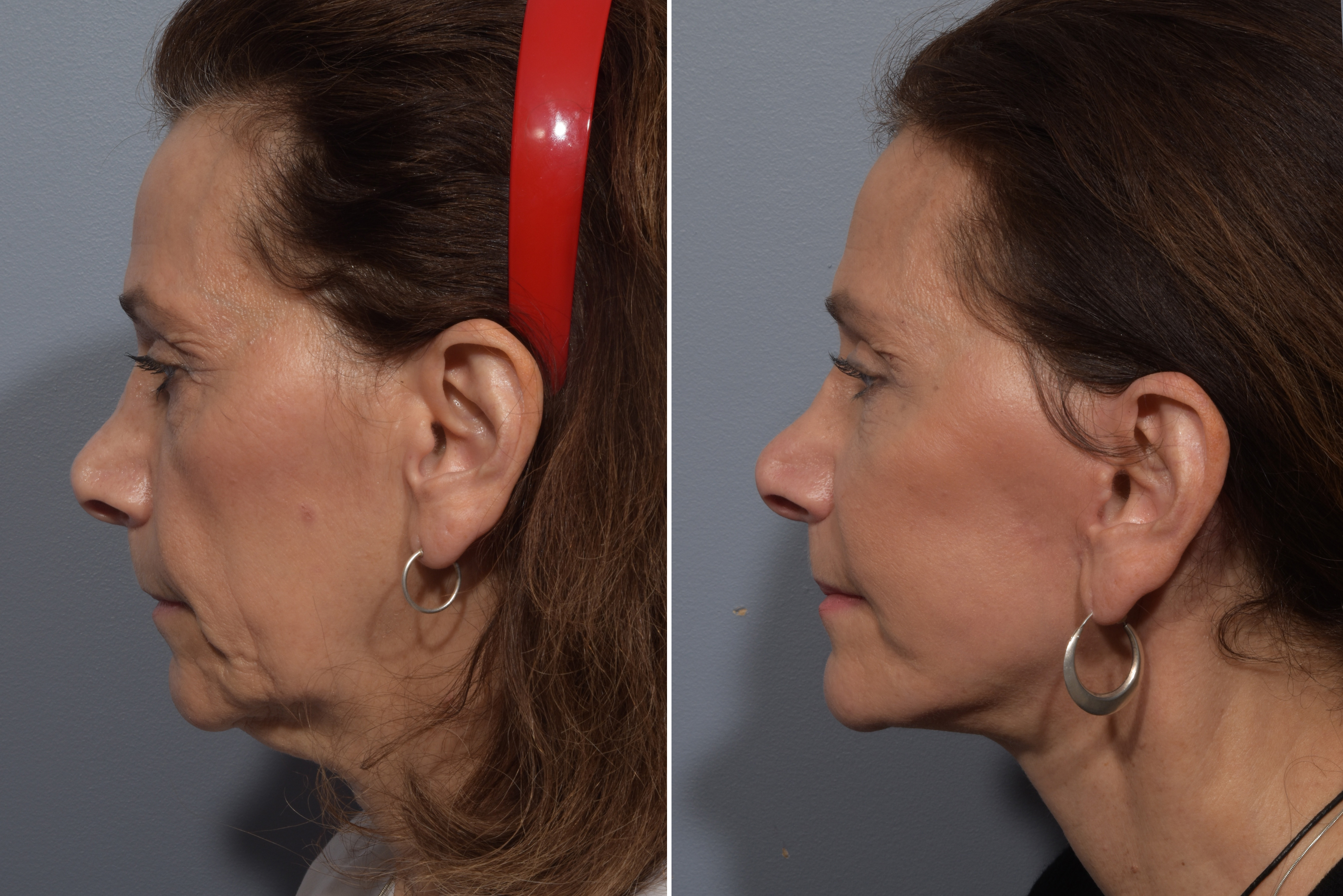 CO2 Laser Before & After Gallery - Patient 246063 - Image 5
