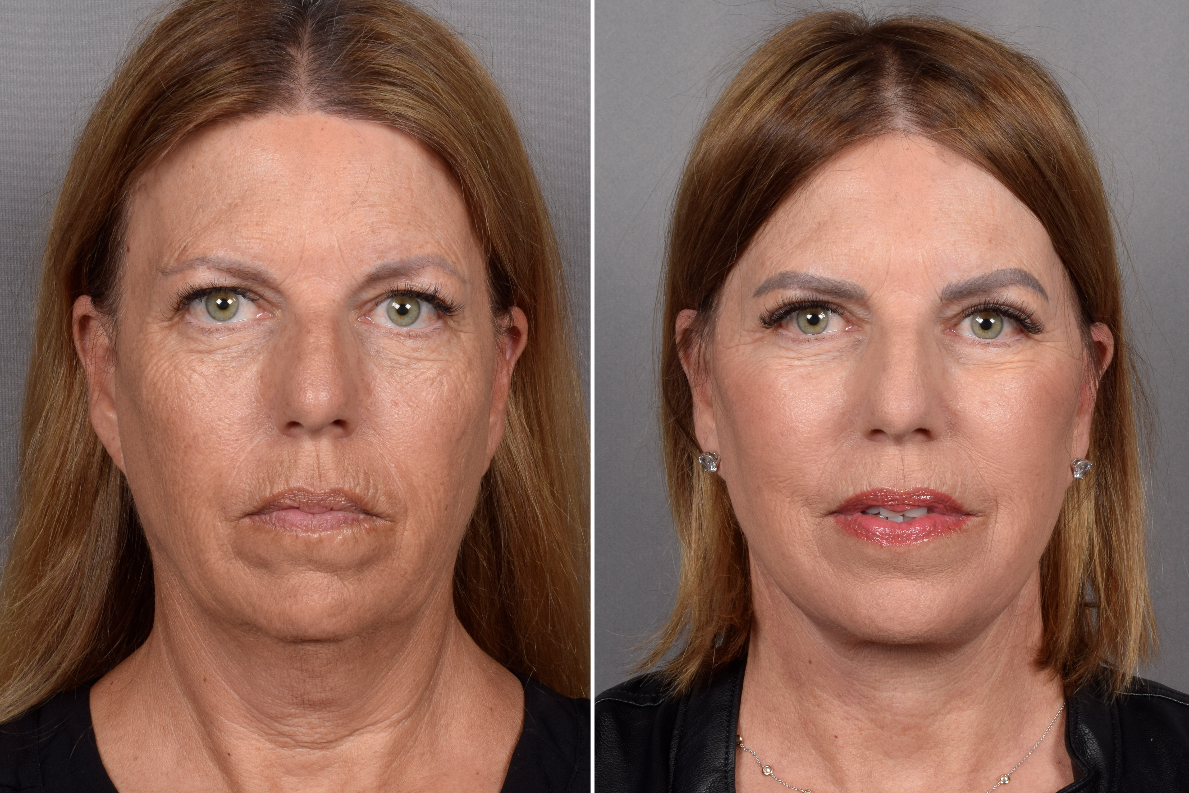 Facelift Before & After Gallery - Patient 707494 - Image 1