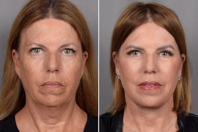 Facelift Before & After Gallery - Patient 707494 - Image 1