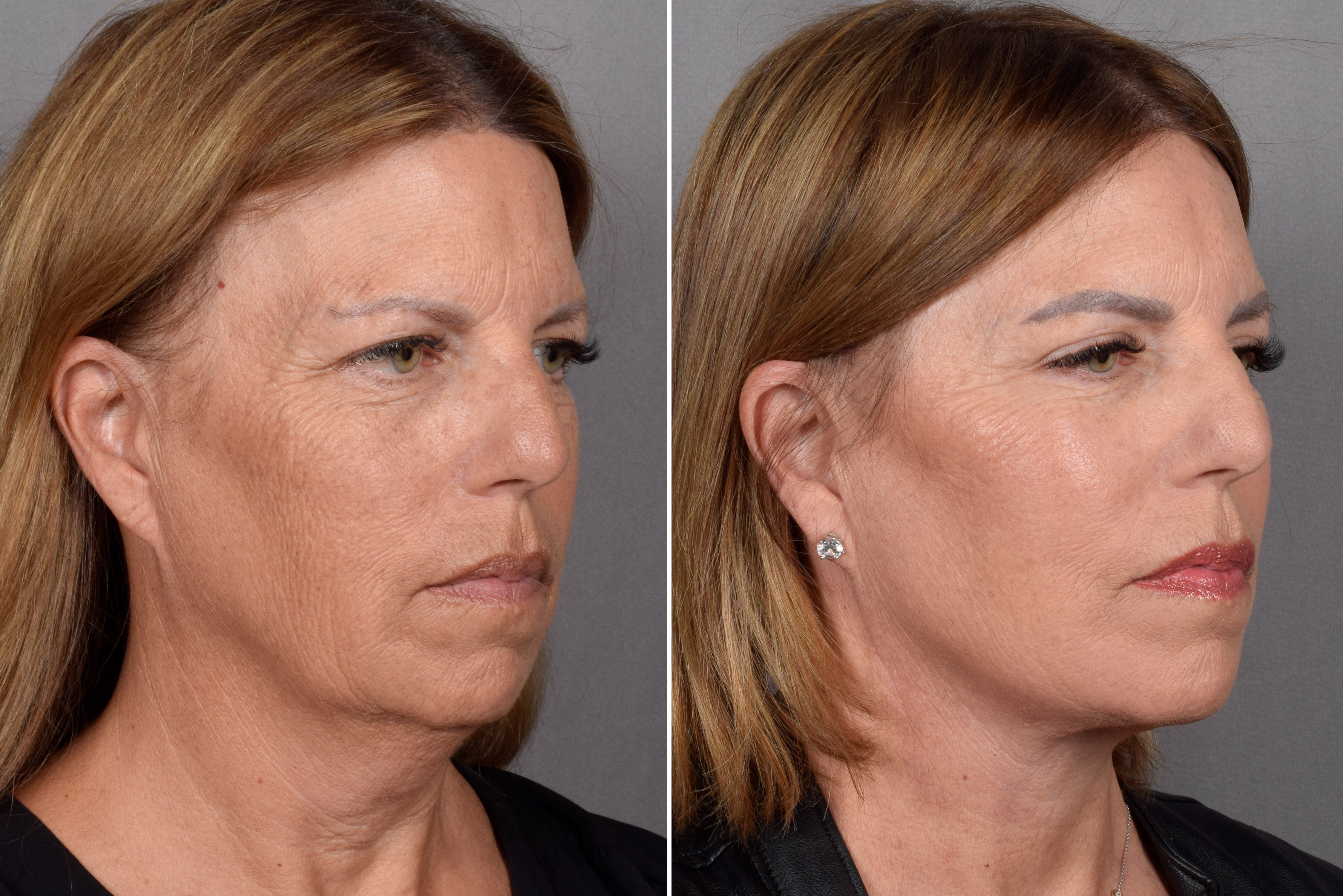 Facelift Before & After Gallery - Patient 707494 - Image 2