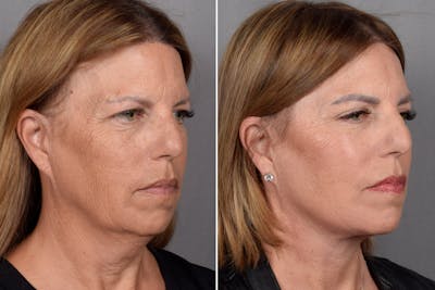 CO2 Laser Before & After Gallery - Patient 410959 - Image 1