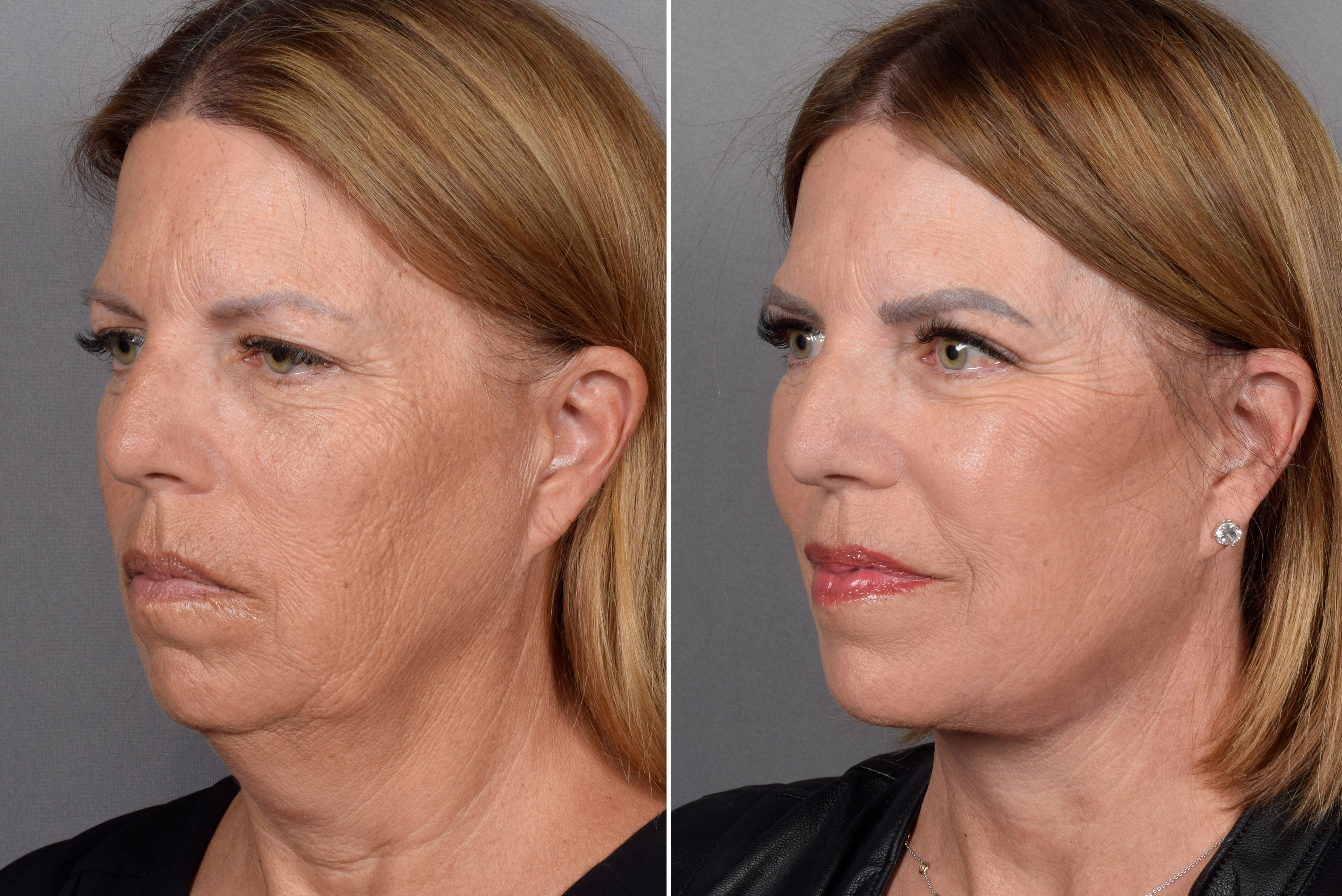 Facelift Before & After Gallery - Patient 707494 - Image 3
