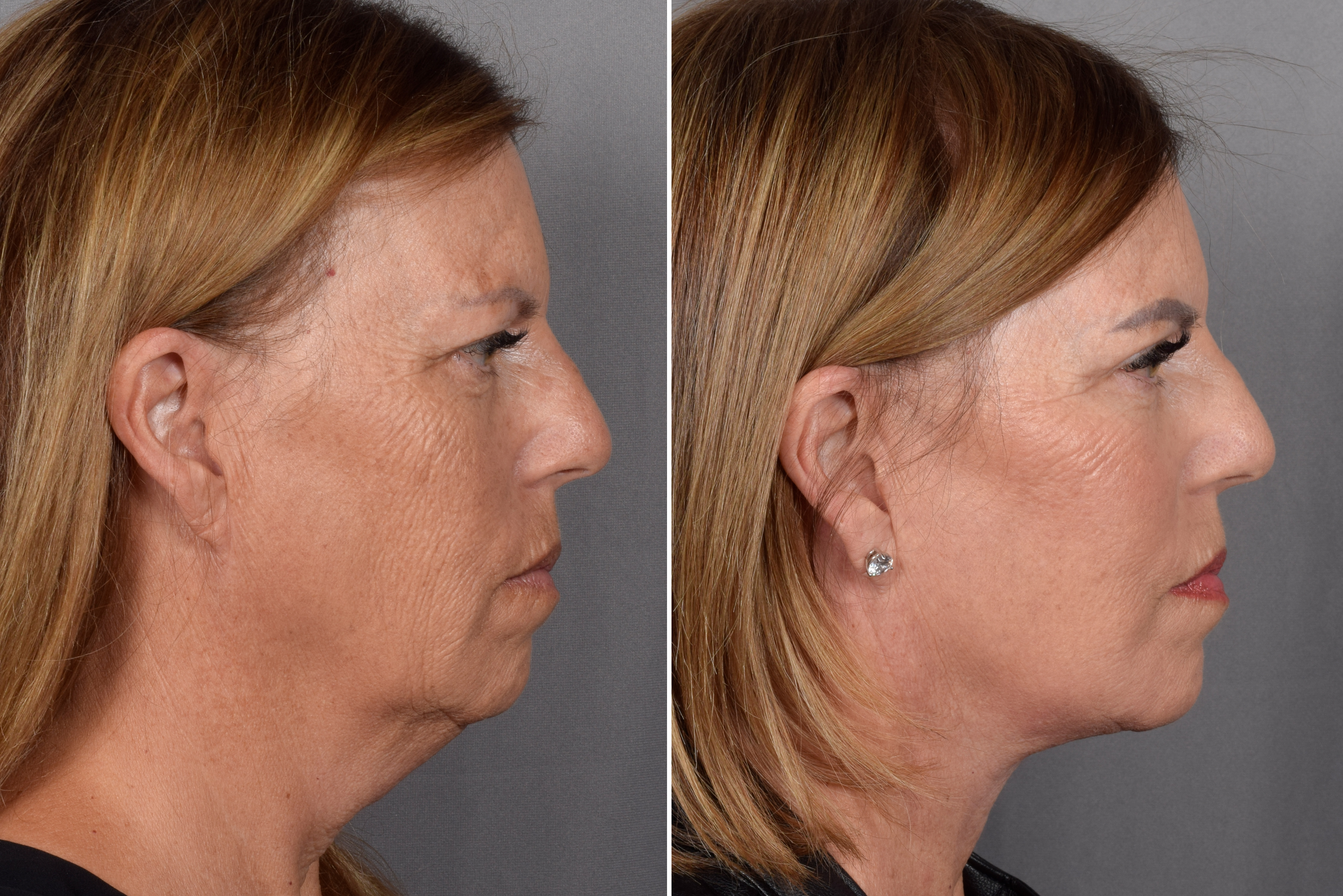 Facelift Before & After Gallery - Patient 707494 - Image 4