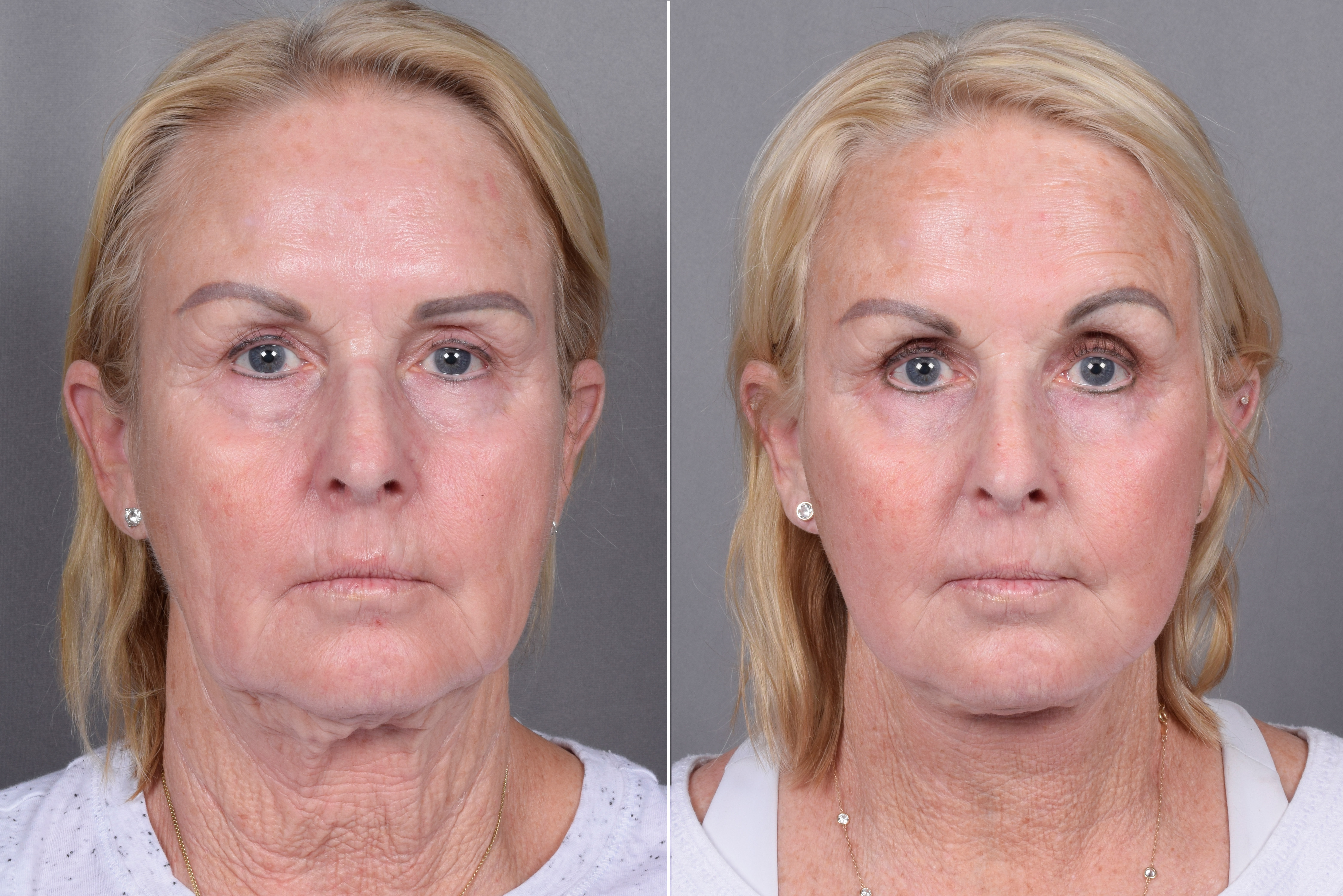 CO2 Laser Before & After Gallery - Patient 317650 - Image 2