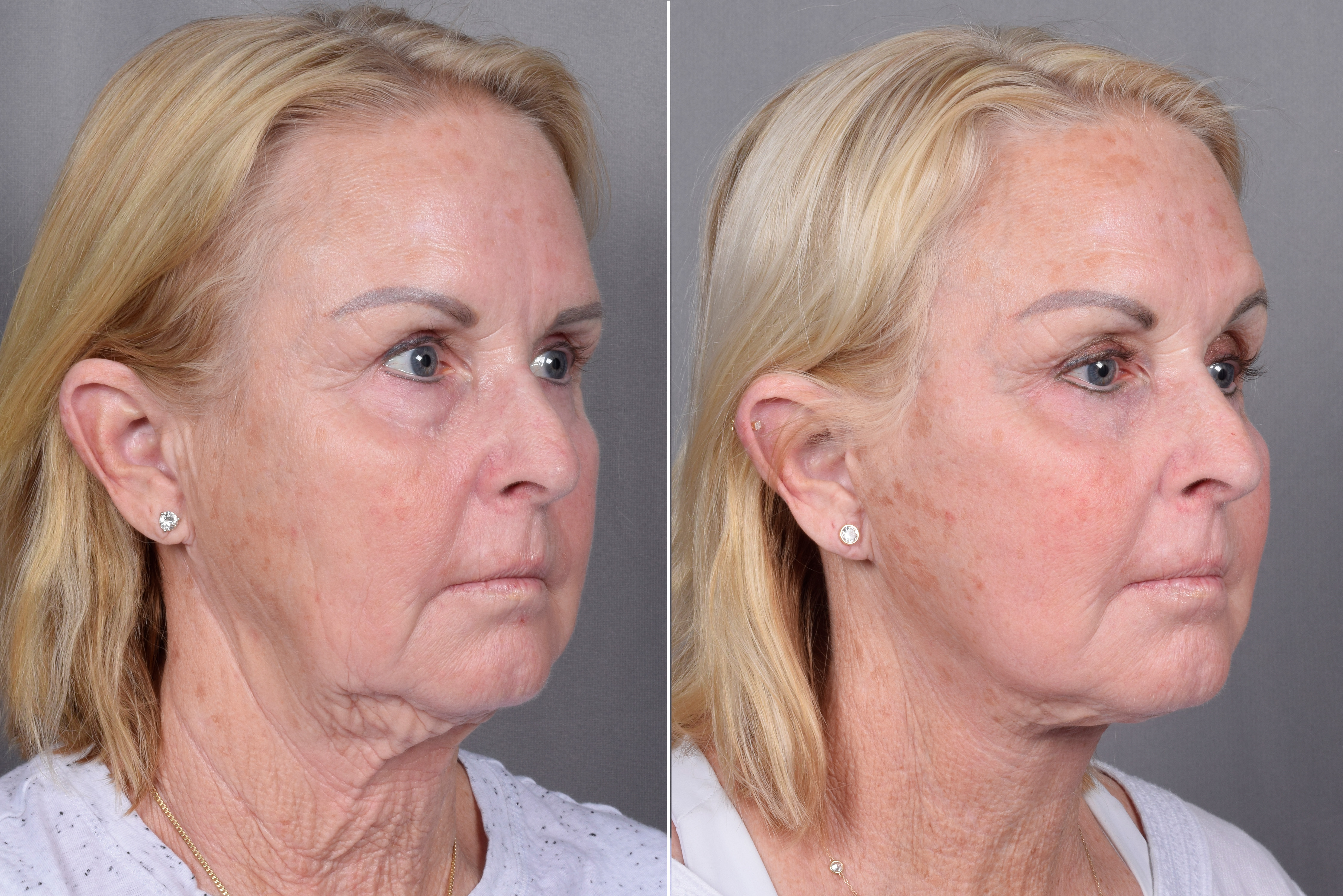 CO2 Laser Before & After Gallery - Patient 317650 - Image 1