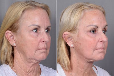 CO2 Laser Before & After Gallery - Patient 317650 - Image 1