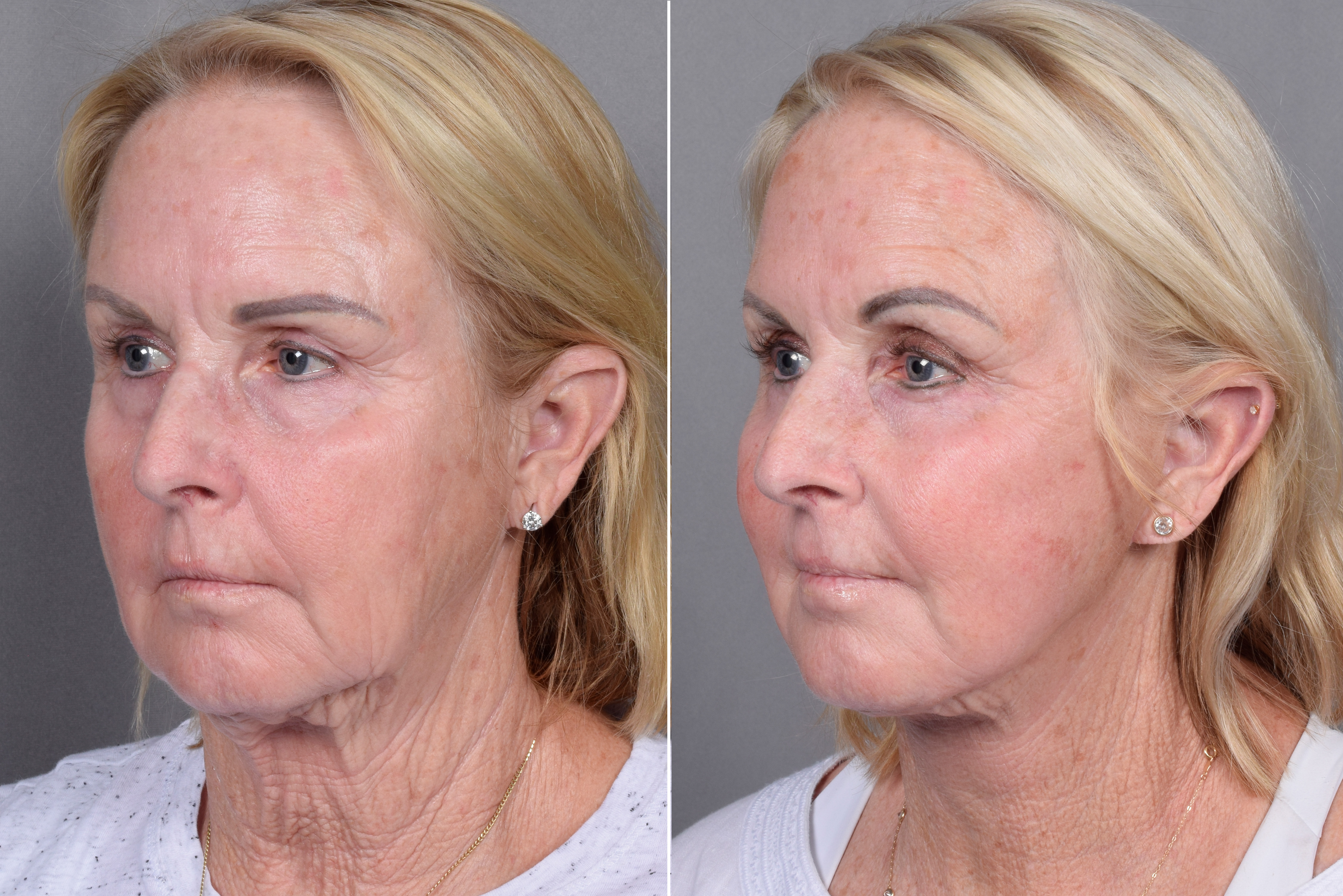 CO2 Laser Before & After Gallery - Patient 317650 - Image 3