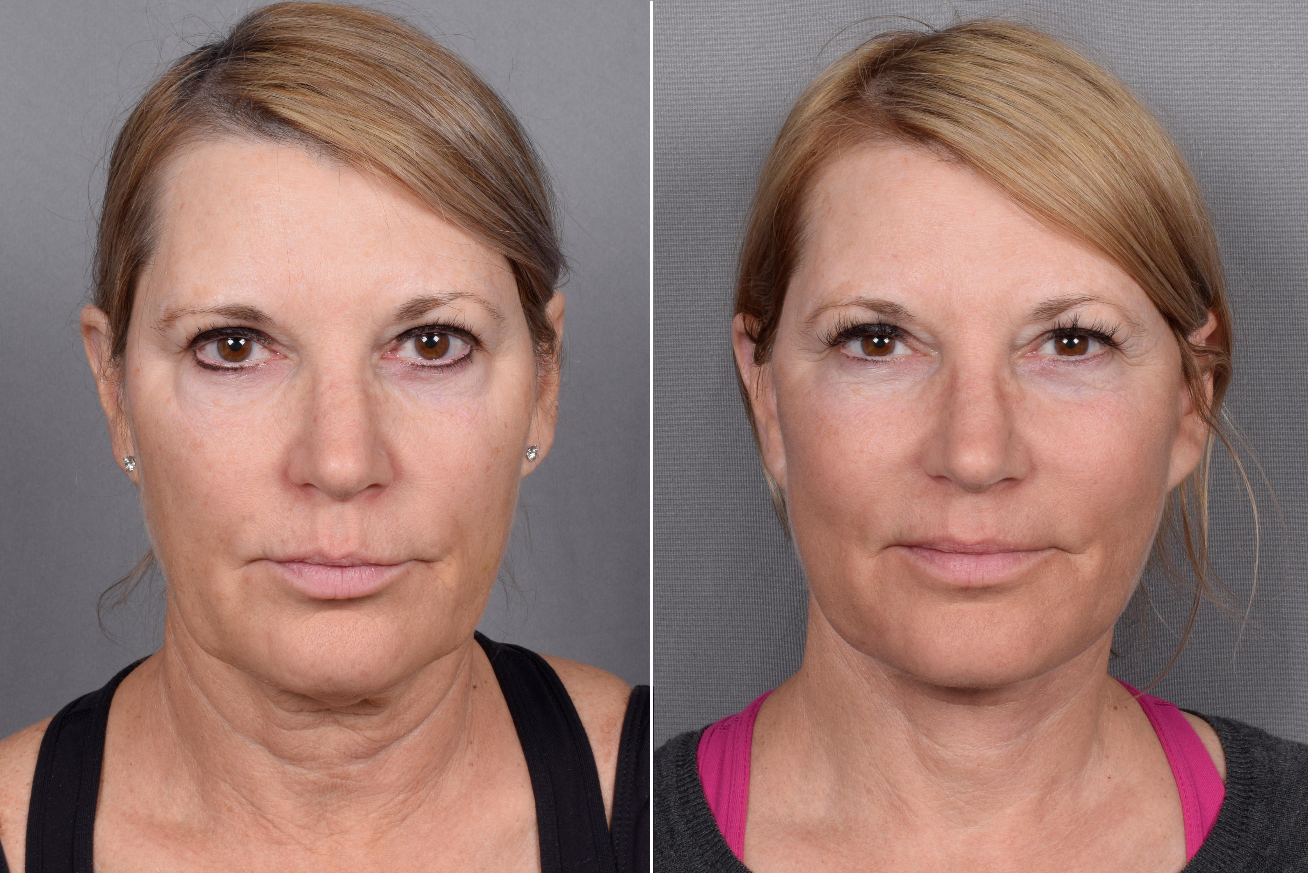 Facelift Before & After Gallery - Patient 219412 - Image 3