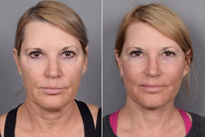 Facelift Before & After Gallery - Patient 219412 - Image 1