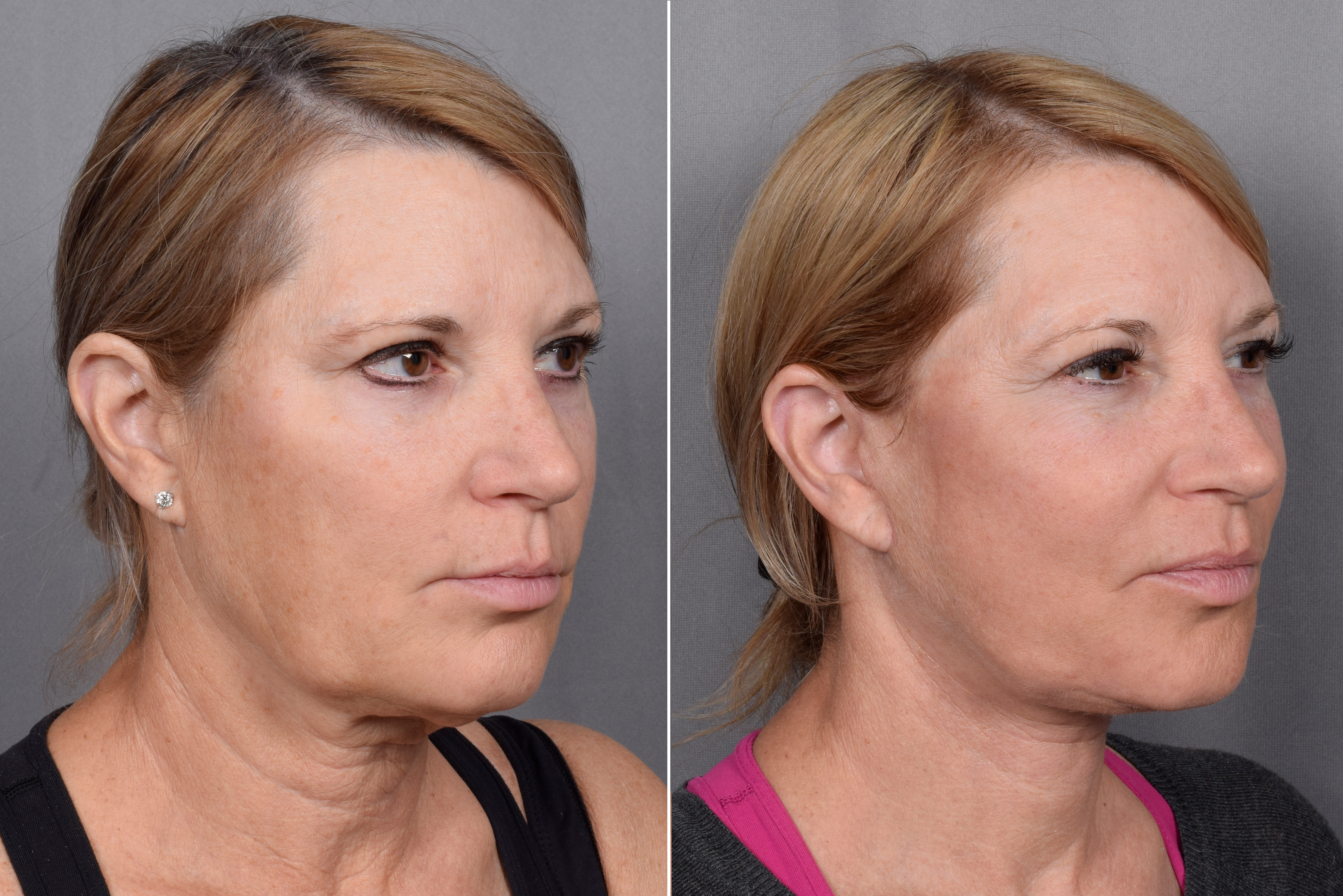Facelift Before & After Gallery - Patient 219412 - Image 4