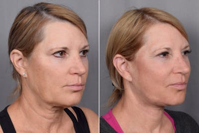 CO2 Laser Before & After Gallery - Patient 362548 - Image 1