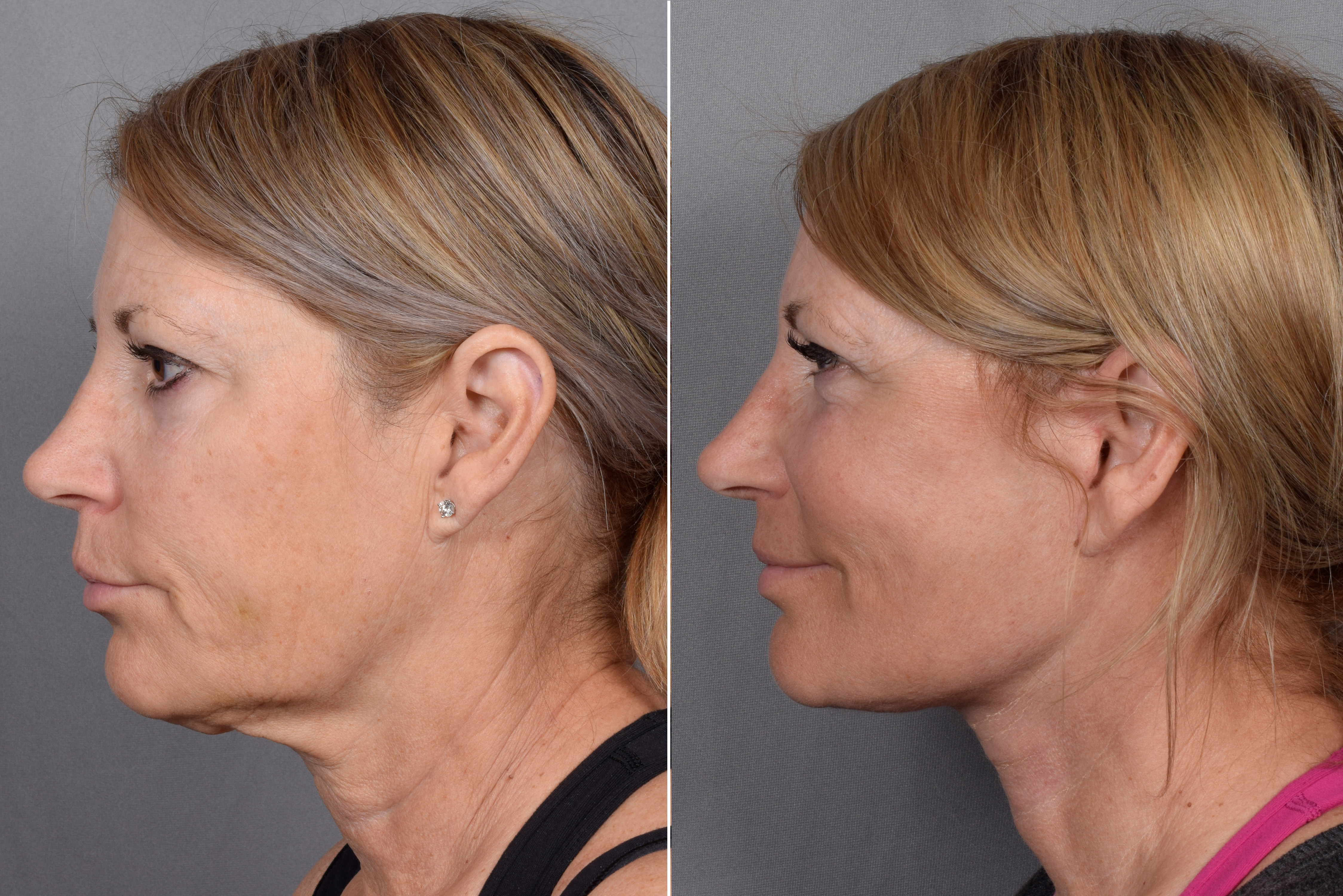 Facelift Before & After Gallery - Patient 219412 - Image 1
