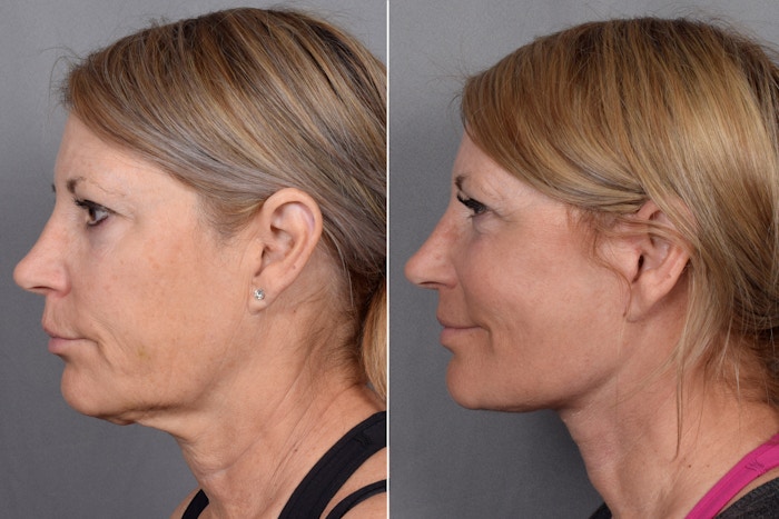Facelift Before & After Gallery - Patient 219412 - Image 1