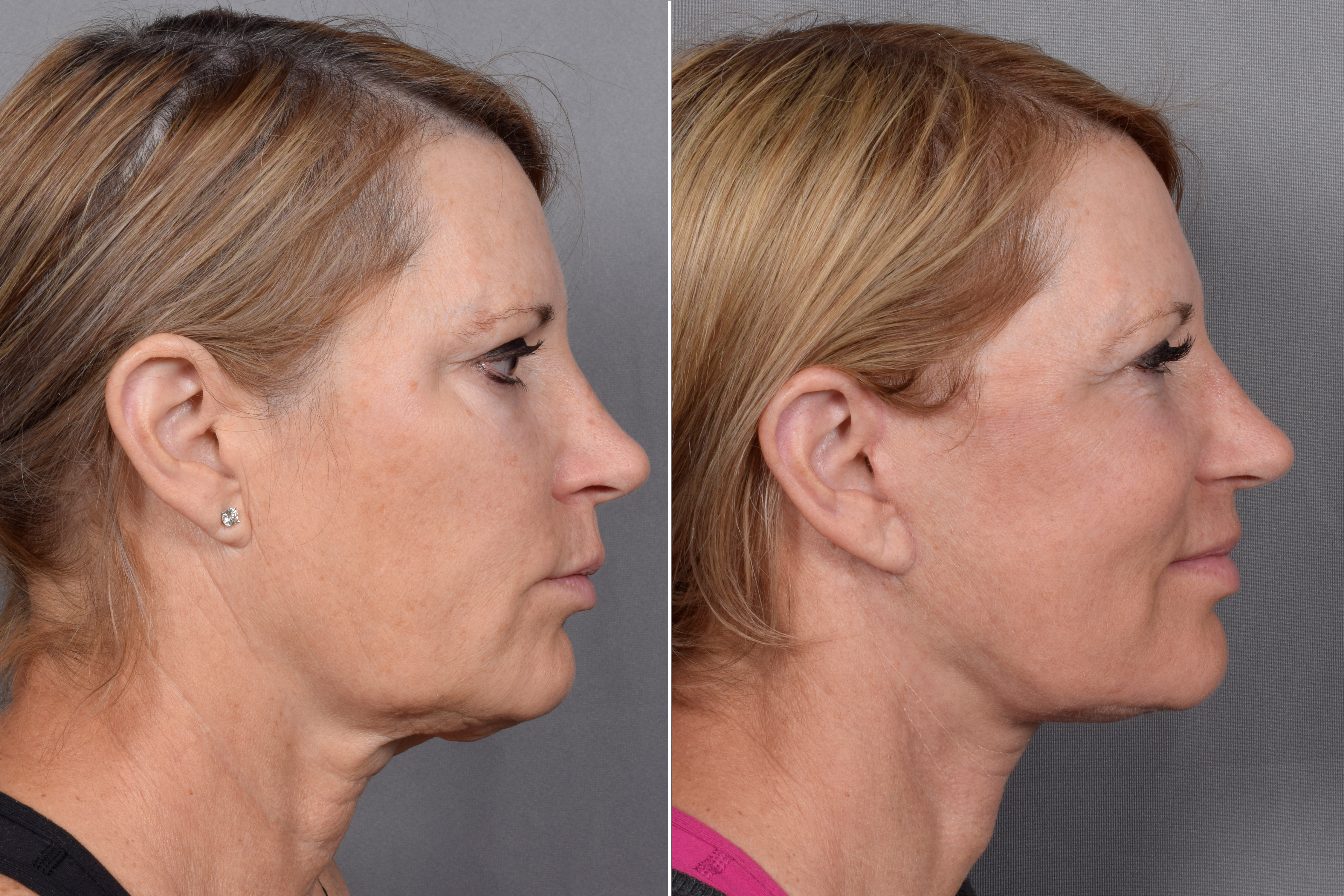 Facelift Before & After Gallery - Patient 219412 - Image 5
