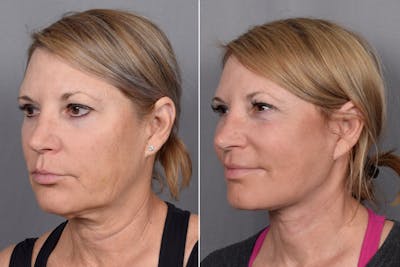 Facelift Before & After Gallery - Patient 219412 - Image 1