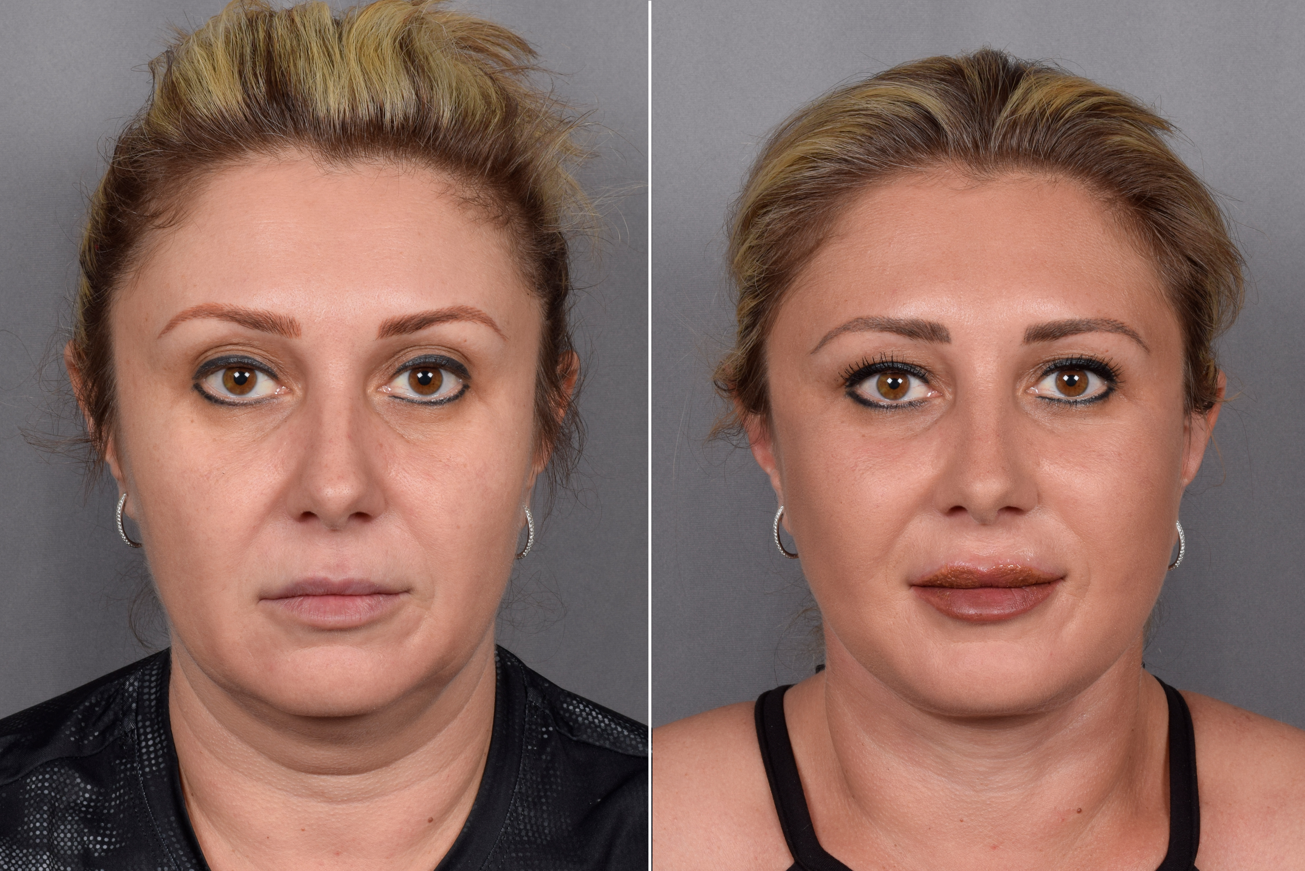 Facelift Before & After Gallery - Patient 177189 - Image 1