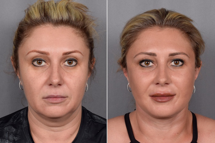 Facelift Before & After Gallery - Patient 177189 - Image 1