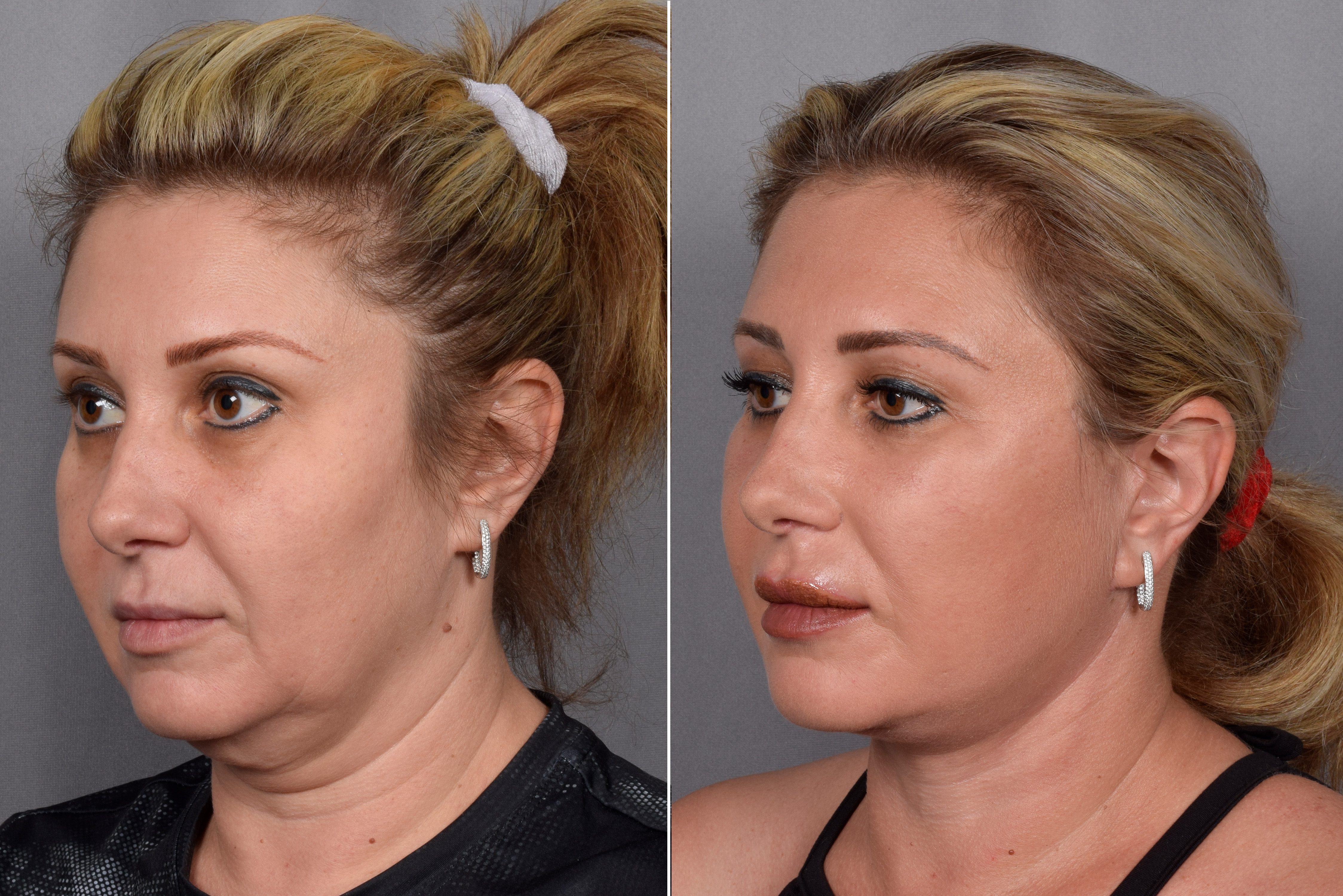 Facelift Before & After Gallery - Patient 177189 - Image 3